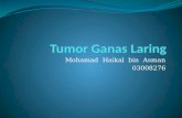 Tumor Ganas Laring