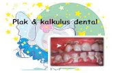 Penyuluhan Plak & Kalkulus Dental