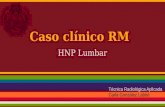 Caso clínico RM HNP lumbar